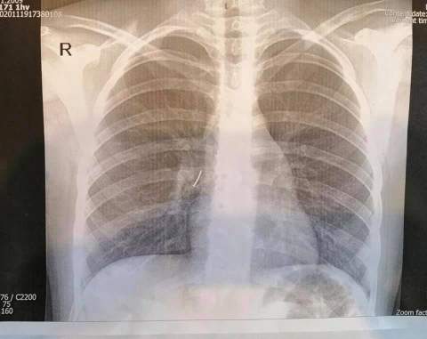 Українські лікарі врятували дівчинку, яка вдихнула цвях (фото)